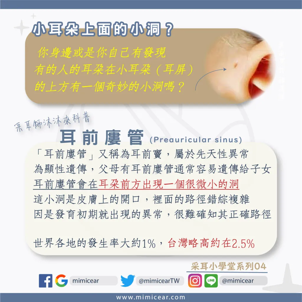 耳前廔管_耳朵上的小孔