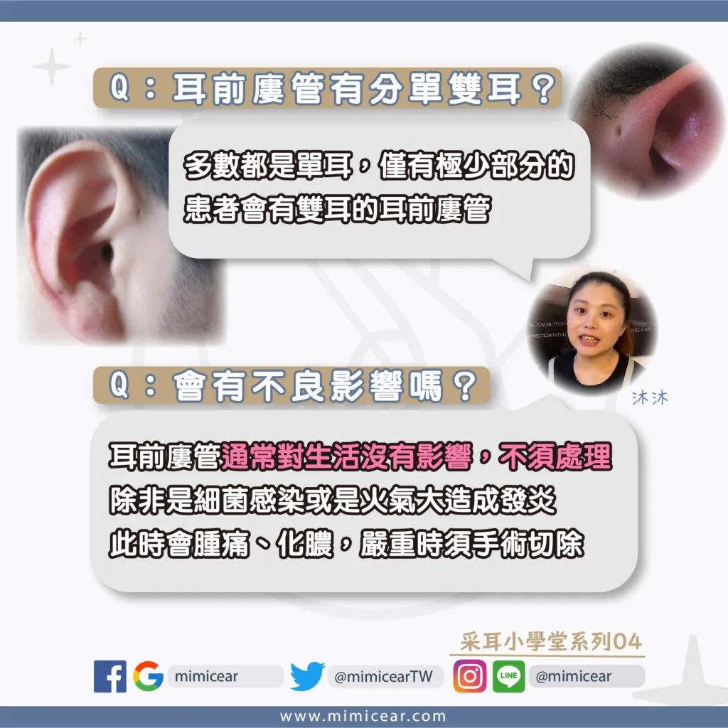 耳前廔管_單耳雙耳
