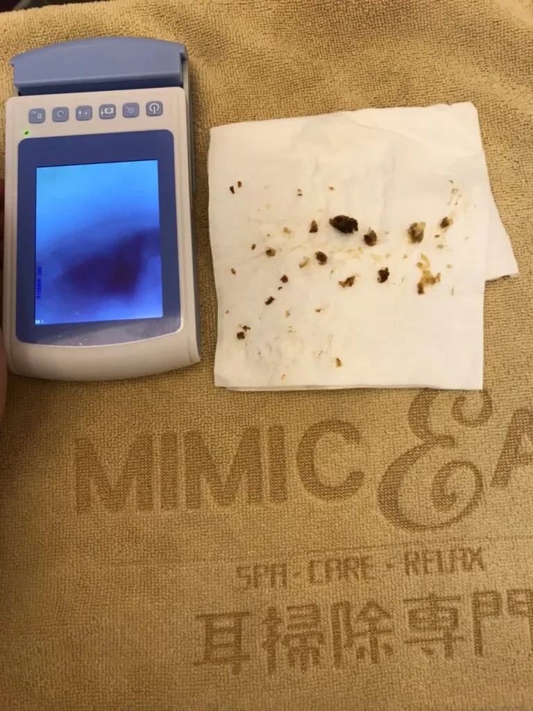 耳結石的照片
