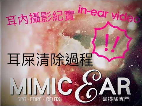 【耳內攝影紀實—耳屎刮除篇】